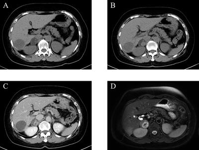 Adrenal Hemorrhage in a Cortisol-Secreting Adenoma Caused by Antiphospholipid Syndrome Revealed by Clinical and Pathological Investigations: A Case Report